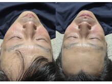 スリール(sourire)/ビフォーアフター