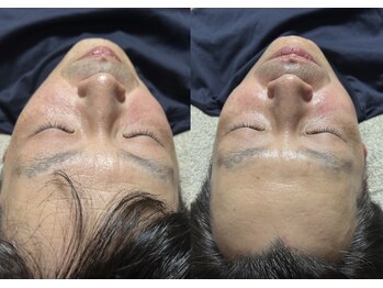 スリール(sourire)/ビフォーアフター