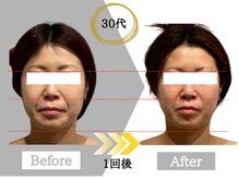 ジャパ(JAPA)/話題のレッドショットで小顔に♪