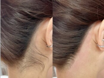 アイラブワン 大和 南林間店(eye love one)/うなじWAX脱毛【大和市】