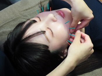 オードヴィー整骨院/深層リフトアップ美容鍼