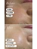 【シミ・赤みが気になる方へ】くすみを飛ばして透明感UP◎光フェイシャル