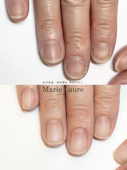 マリーロール 梅田店(Marie Laure)/自爪育成/深爪矯正/ネイルケア