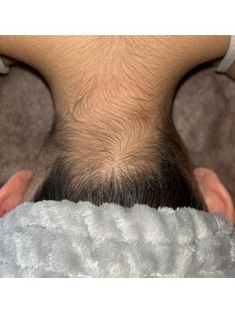 ベルフィオーレ(bel fiore)/10代女性 初回 Before