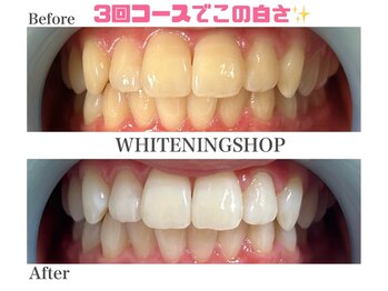 ホワイトニングショップ 名古屋店/【ビフォーアフター】3回コース