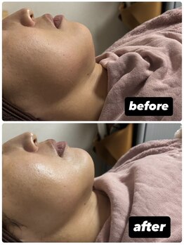 スウスウ 福岡糟屋(su:su)の写真/小顔×ツヤ肌が叶う！ピーリング・水光肌トリートメント・エイジングケアトリートメント・炭酸ガスパック