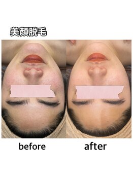 エステティックレイビス 名古屋店(RAYVIS)/美肌ケア+全顔脱毛