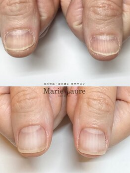マリーロール 梅田店(Marie Laure)/自爪育成/深爪矯正/ネイルケア