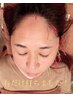 お悩み解決！！☆【和揉式】美容鍼★60分7500円