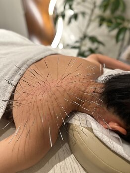 ランスソア(L'ins soi)/鍼 ルート鍼