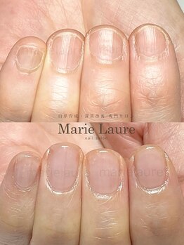 マリーロール 梅田店(Marie Laure)/自爪育成/深爪矯正/ネイルケア