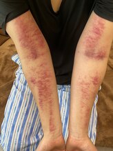 コル コルエ(koru korue)/入院後の老廃物を促しに来ました