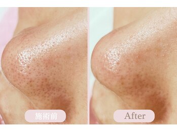 エピル(EPIL)/DEEPクリアスキン毛穴洗浄症例