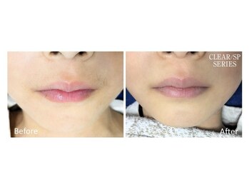 フォーティチュード(FORTITUDE)/お子様の口周りのうぶ毛