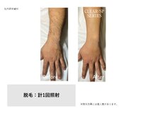 トータルクリア(TOTAL CLEAR)/男性腕脱毛