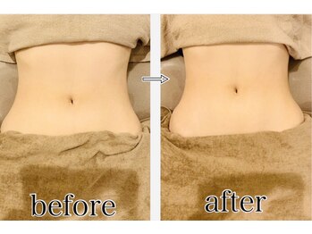 オリエンタル ルボワール(oriental Revoir)/下半身骨盤矯正カッピング