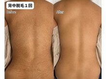 レミーラ(Remira)の雰囲気(【背中脱毛】夏に向けて脱毛しませんか?見えない所こそ綺麗に♪)