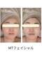 フルリール(fleurir)の写真/美容クリニックでも使用のMTフェイシャルで理想の素肌へ！敏感肌・乾燥肌もOKの丁寧なエイジングケア体験♪