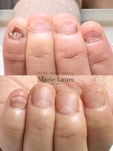 マリーロール 梅田店(Marie Laure)/自爪育成/深爪矯正/ネイルケア
