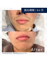 メンズクリア 藤沢OPA店/【メンズクリア】お客様の施術例