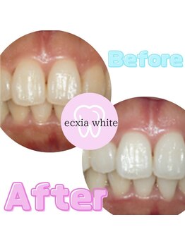 エクシアホワイト 新宿御苑店(ecxia white)/ホワイトニングビフォーアフター