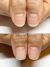 マリーロール 梅田店(Marie Laure)/深爪矯正/自爪育成/自爪風