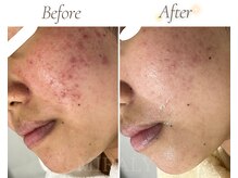 ミラリー(MIRALY)/頬・ニキビケア 12ヶ月(20代)