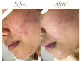 ミラリー(MIRALY)/頬・ニキビケア 12ヶ月(20代)