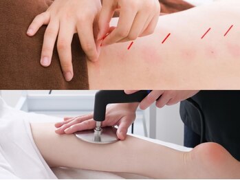 アキュセル ヨウコナース アンド 暢子美容鍼灸(Accu:Cell Youko nurse)の写真/【女性鍼灸師/美容鍼灸】美容鍼×フェイシャルで小顔施術を受けたい方に☆2つの施術効果で持続力を更にup!