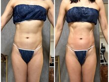 フュース(Futh)/脂肪分解マシンセルヒートコース