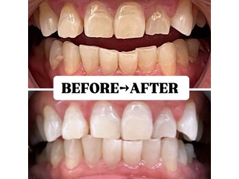 ホワイトニングサロン 宝塚/Before&After美白ホワイトニング