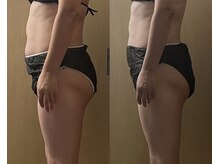 モモリラ(momorila)/活性リンパ洗浄