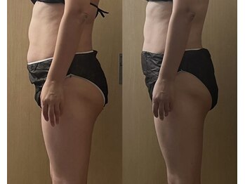 モモリラ(momorila)/活性リンパ洗浄