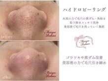 メゾンリュバン 梅田店(Maison Ruban)/毛穴洗浄・美白フォト|毛穴ケア