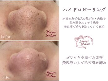 メゾンリュバン 梅田店(Maison Ruban)/毛穴洗浄・美白フォト|毛穴ケア