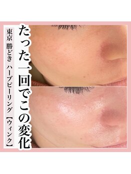 ウィンク 勝どき(wink)/ハーブピーリング