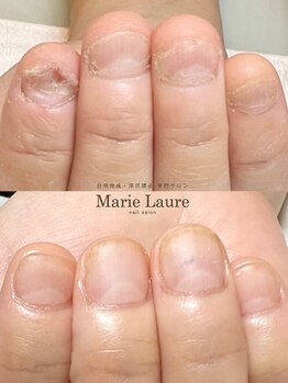 マリーロール 梅田店(Marie Laure)/自爪育成/深爪矯正/ネイルケア