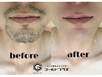 ゴールドプラス 新倉敷店(GOLD PLUS)/ヒゲWAX脱毛ビフォーアフター