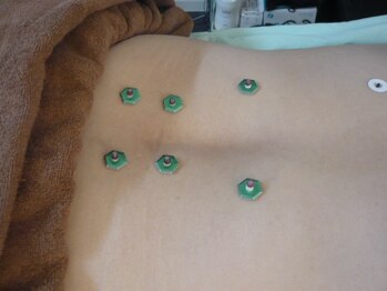 アタック鍼灸院(ATAC鍼灸院)/腰部へのお灸