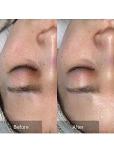 ホワイトアクア 錦糸町店(WHITE AQUA)/ララピール/東京/錦糸町/毛穴