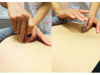 柏鍼灸整骨院/鍼灸施術