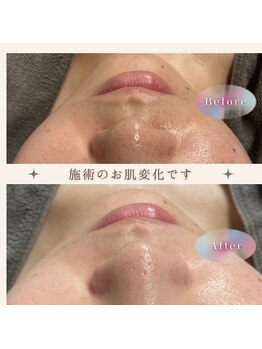 ルルーディア(LOULOUDIA)/毛穴洗浄、クリアな美肌へ♪