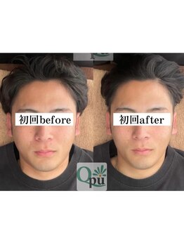 キュープ 群馬吉岡店(Qpu)/初回でこの効果！劇的小顔