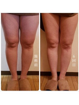 ロージーハピネス(Rosy happiness)/RFキャビテーション　痩身