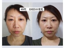 ベルフィオーレ/再生美容コース TGF導入小顔矯正