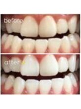 エクシアホワイトニング 津駅前店/お客様ビフォーアフター