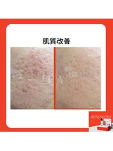 フェリス(feliz)/ララピール[ニキビケア/肌管理]