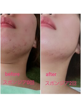 サロンド カナネ/スポンジアトリートメント