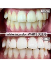 ホワイト 天王寺店(White)/Whitening症例before→after