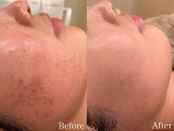 ビューティ ワンド ユズ(Beauty Wand YUZZ)/花粉SOSトリートメント 2回